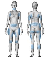 Tratamiento corporal - Zonas criolipólisis